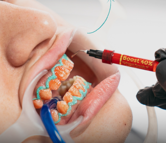 Blanqueamiento dental profesional