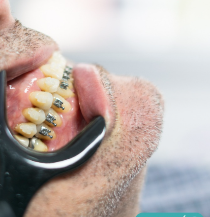 Ortodoncia con brackets