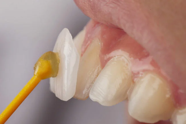 Carillas dentales estéticas